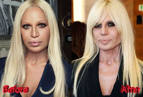 donatella versace armor dress|donatella before and after.